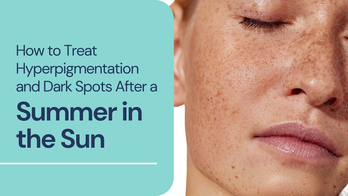 How to Treat Hyperpigmentation and Dark Spots After a Summer in the Sun